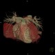 CT angiography of heart: CT - Computed tomography